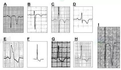 形形色色的t波倒置你了解多少