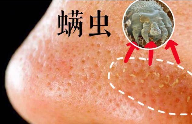 螨虫在身上疯狂活动,皮肤又痒又油还长痘,学学专家的除螨大法