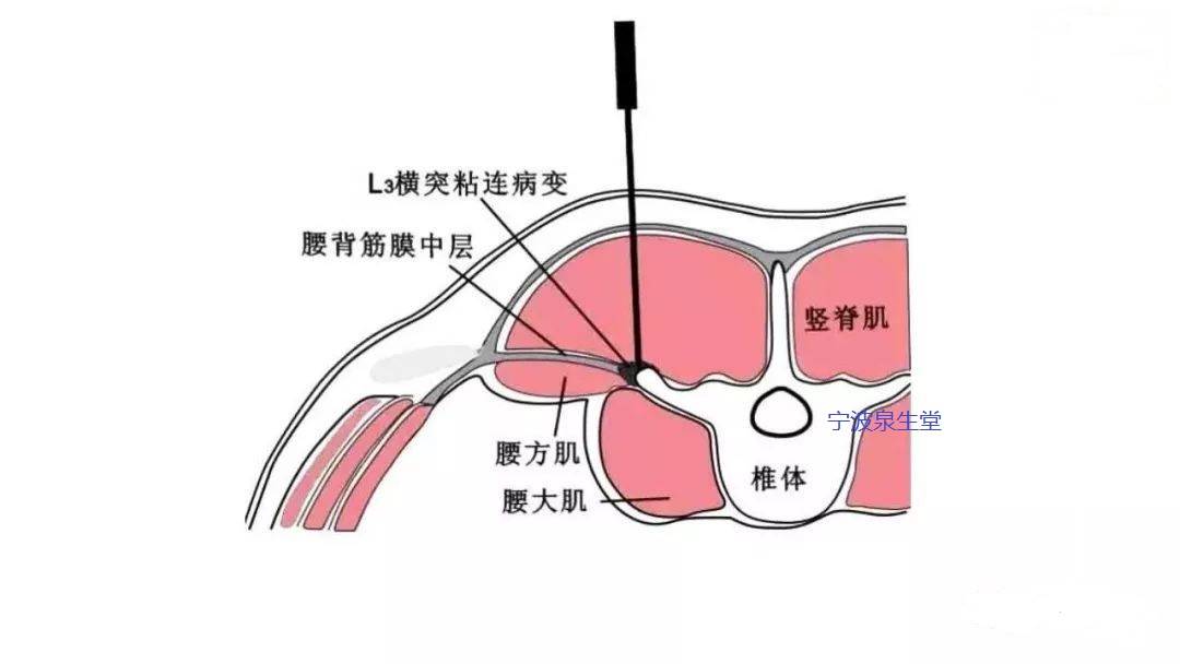 第三腰椎横突位置图图片