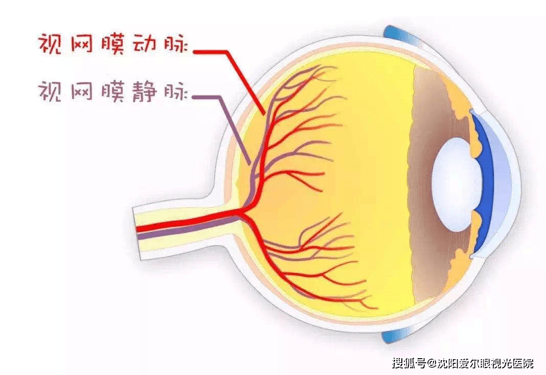 马利波教授介绍,眼睛中风是指眼睛视网膜的动脉或静脉血管发生堵塞