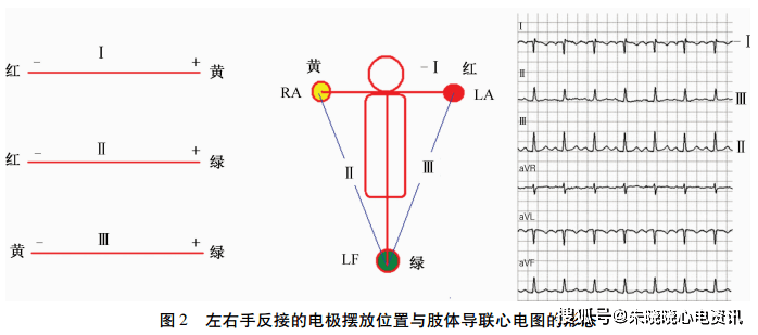 图解肢体导联电极错接的心电图表现