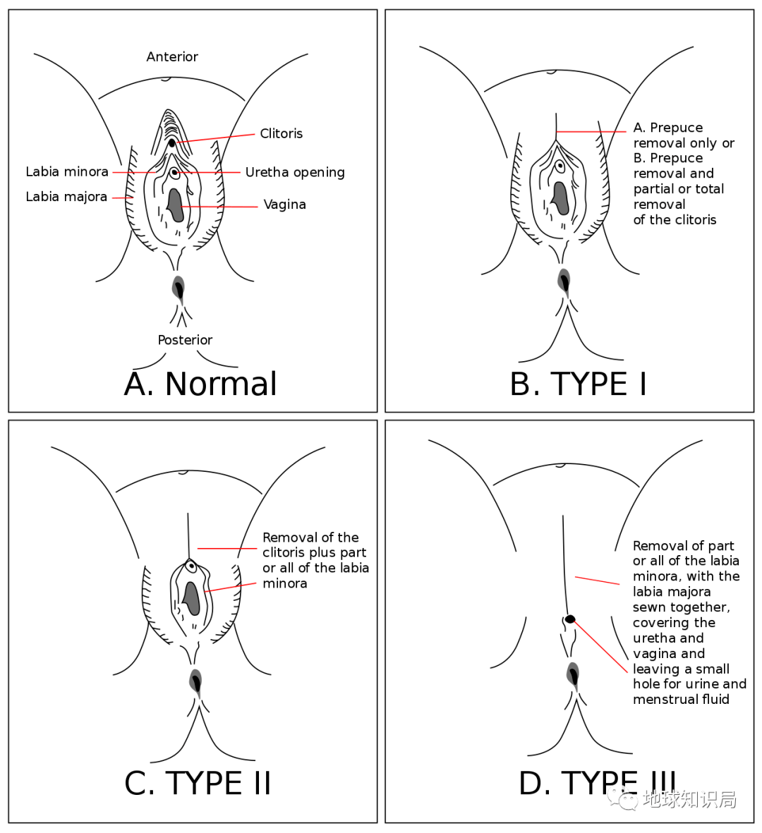 割礼全过程 手术图片