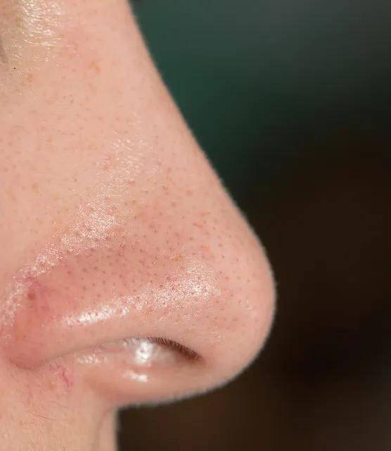 雯雯护肤小科普:你的"黑头"是假的!