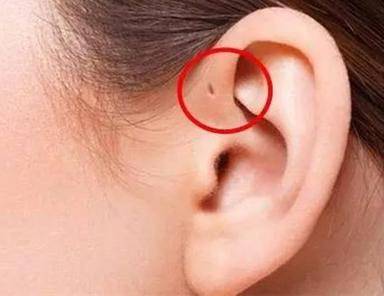 耳朵外耳轮有一个小洞图片