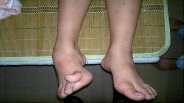 儿童脚变形严重图片图片