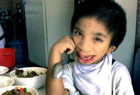 原创"鸟脸"妈不顾遗传生下"鸟脸娃",是母爱还是自私?现状告诉你