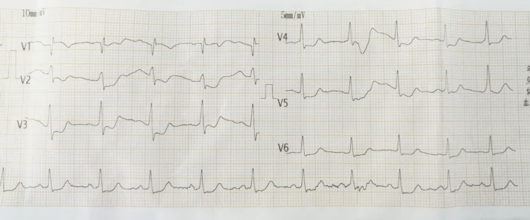 急查心電圖(ecg)顯示avr導聯st段弓背向上抬高,其餘導聯st段均顯著