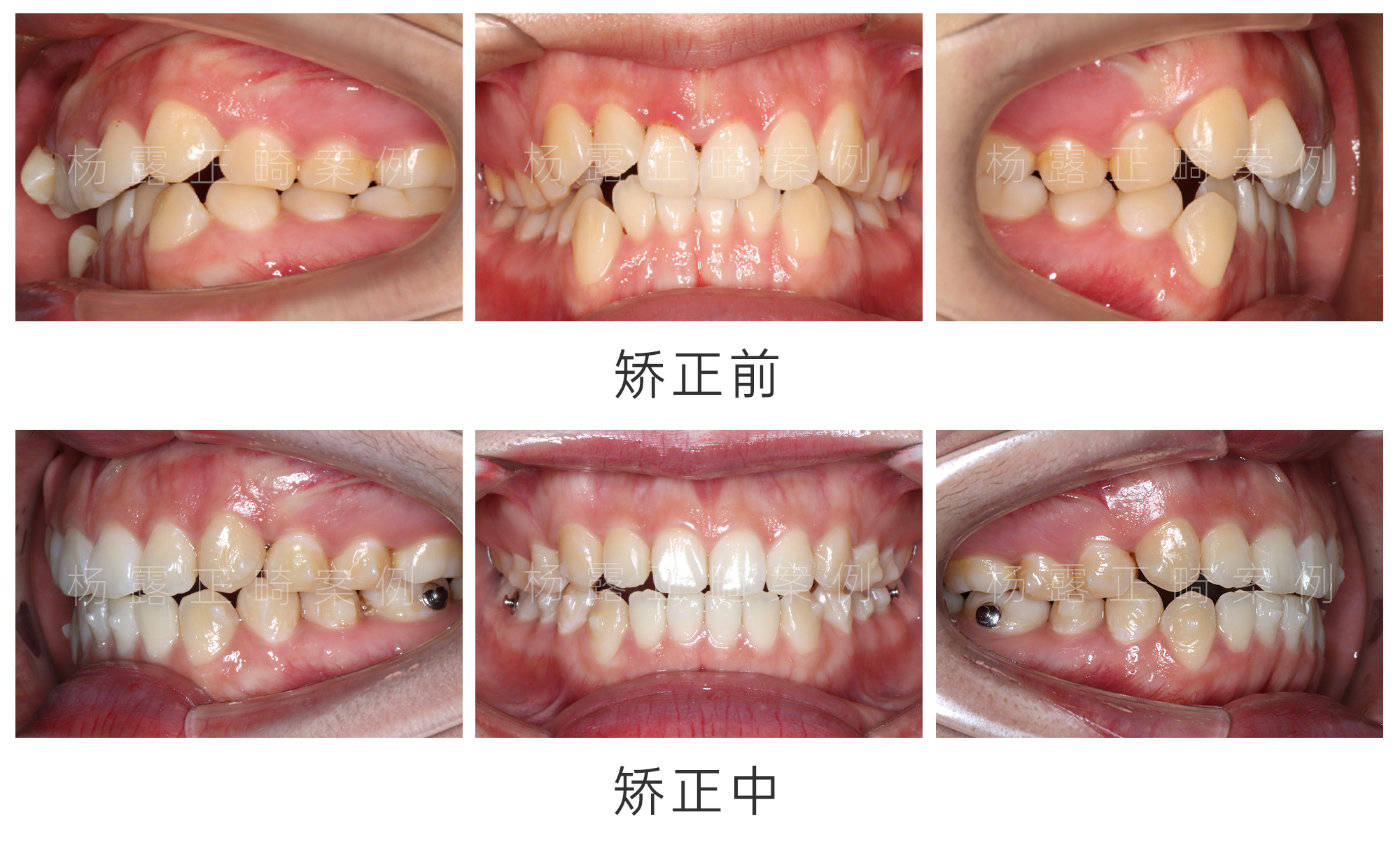 广州牙齿矫正杨露医生│牙列拥挤,前牙咬合关系不佳正畸案例