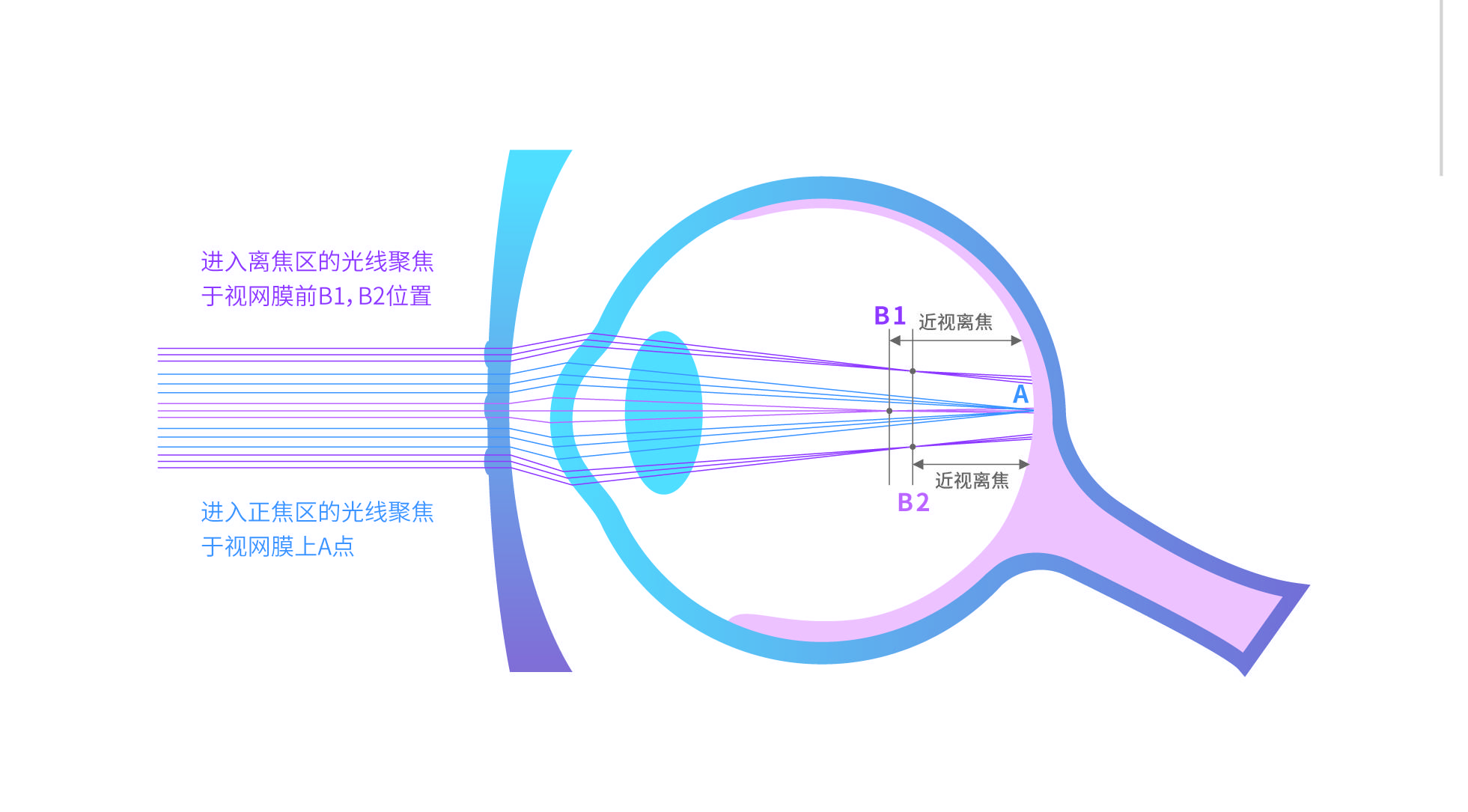 图2 原理图此外,王教授还提醒家长们:一定要重视视力问题对孩子成长的