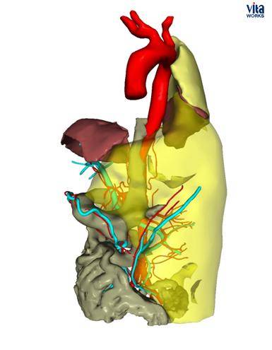 术前三维重建侯生才副院长带领团队攻克手术带血的纱布切除的巨大肿物