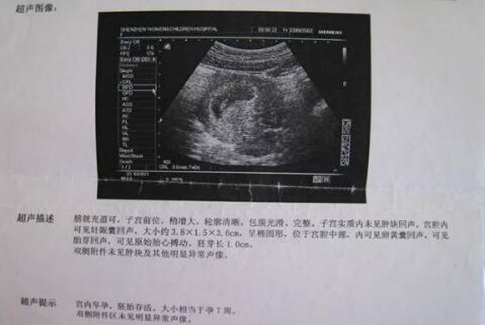 胎儿发育迟缓?孕检三项标准合格说明度过新手期,孕妈可以放心了