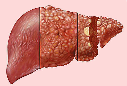 肝癌即肝脏恶性肿瘤