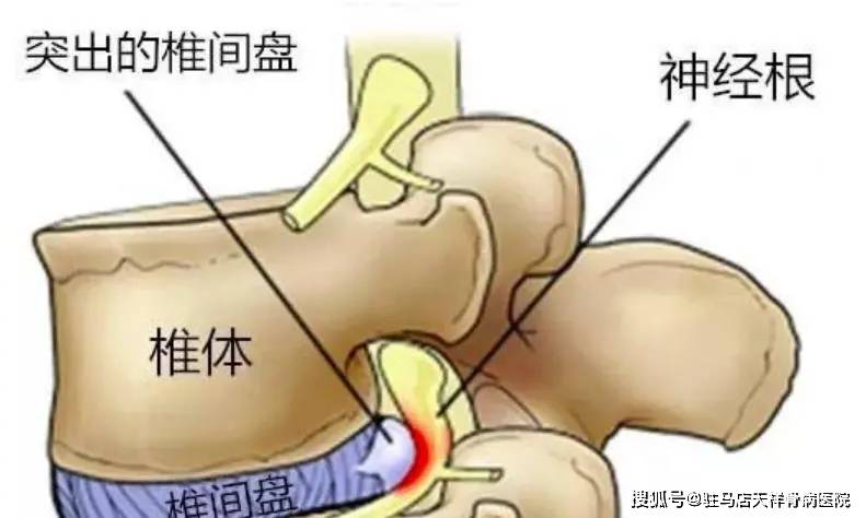 腰椎间盘突出症以腰4