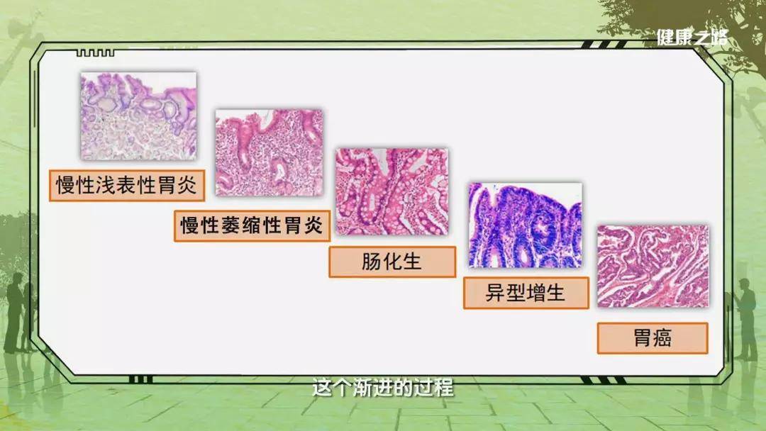 萎縮實際上是指正常胃黏膜的固有腺體數量減少,被其它纖維炎性組織