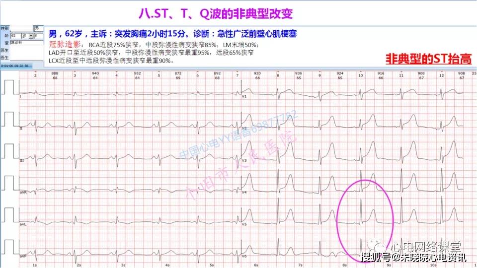 不典型心肌梗死的心電圖改變