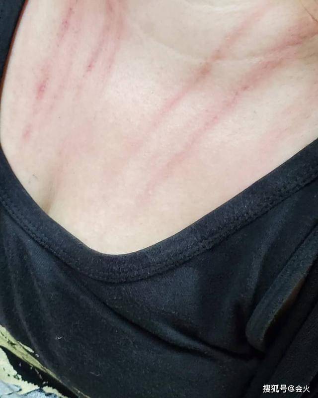 原创歌手称女友整容比妻子怀孕辛苦,与妻子庭外纠纷,抓伤红痕触目