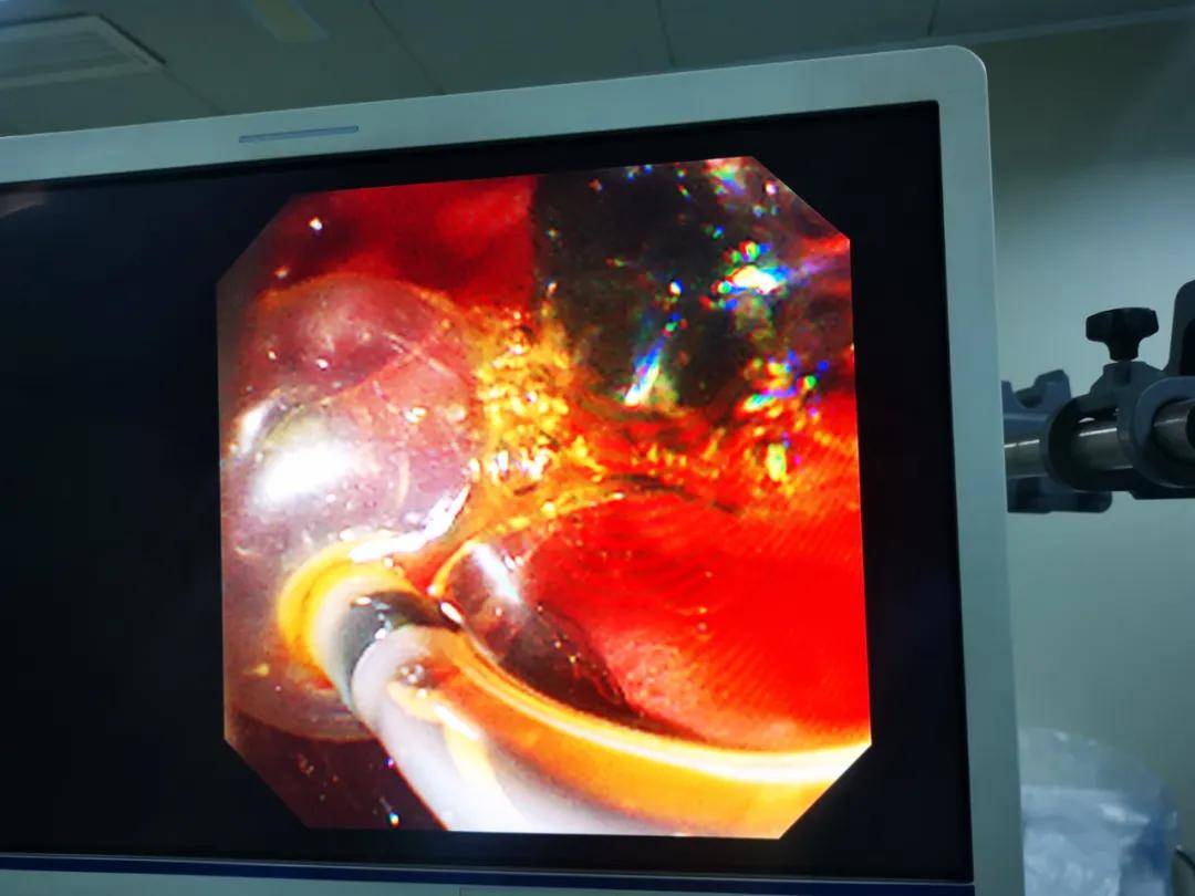 红会医院消化内科 | 郭学刚教授"ercp"技术快速解除患者痛苦