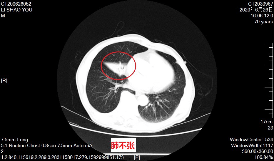 支氣管鏡下成功取出