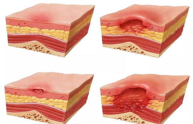 压疮治疗有哪些好的治疗方法?