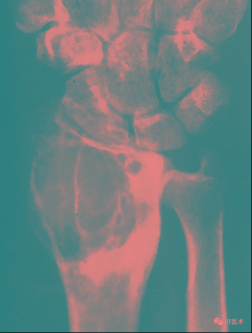 110張經典x線片影像診斷,夜班醫生必備!_橈骨