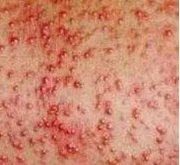 湿热的夏天宝宝易受痱子困扰,从根本"消"痱,祛湿邪