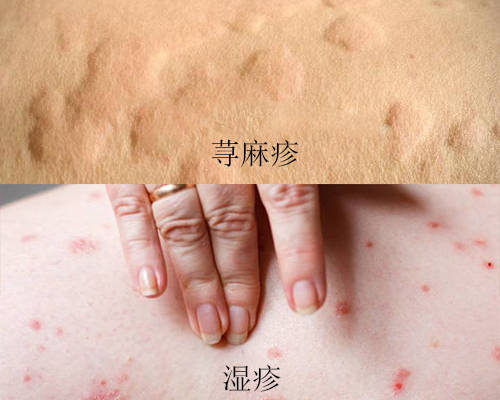胎毒与湿疹的区别图图片