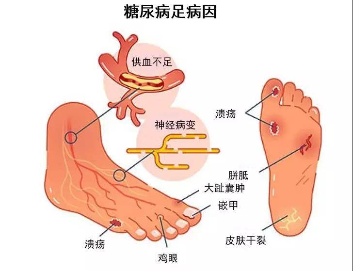 各种脚病名称图片