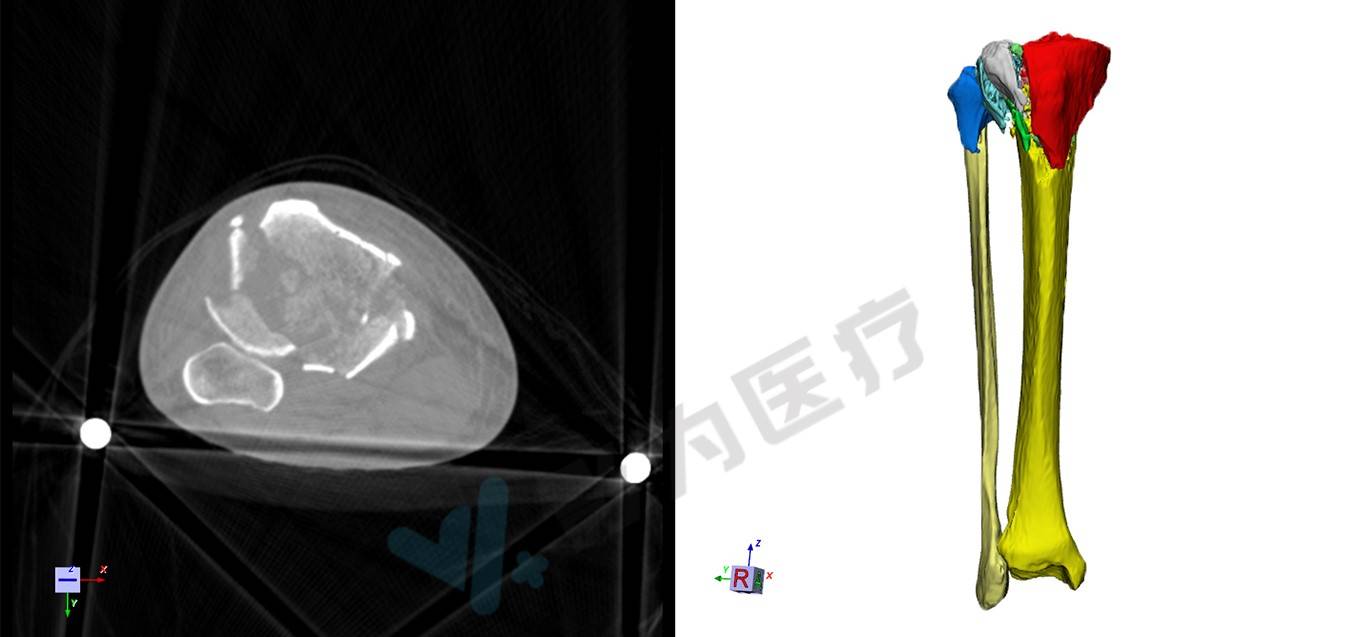 利用自主研发的medraw医学影像三维建模系统进行了胫骨平台的三维重建