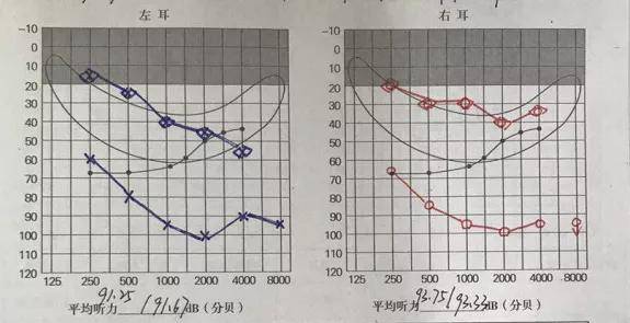 25和92.5分贝,推荐进行基因检测,分析孩子听力下降原因,期待可以