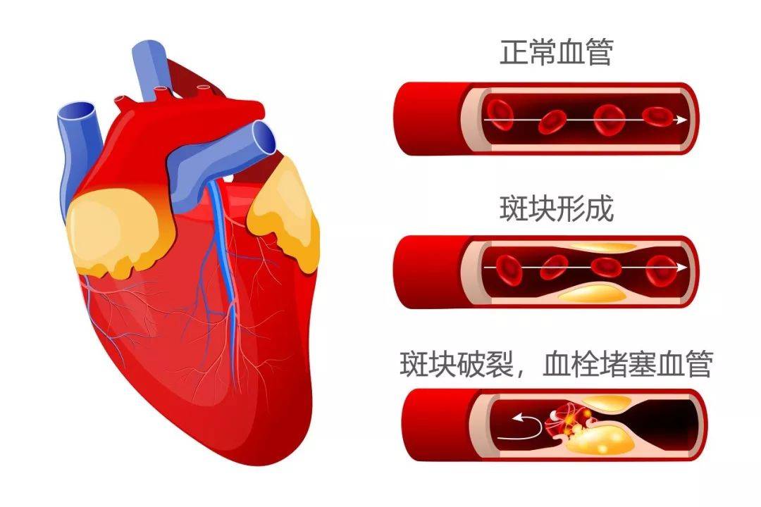 高血压如何引起动脉粥样硬化?医生:主要从2个方面