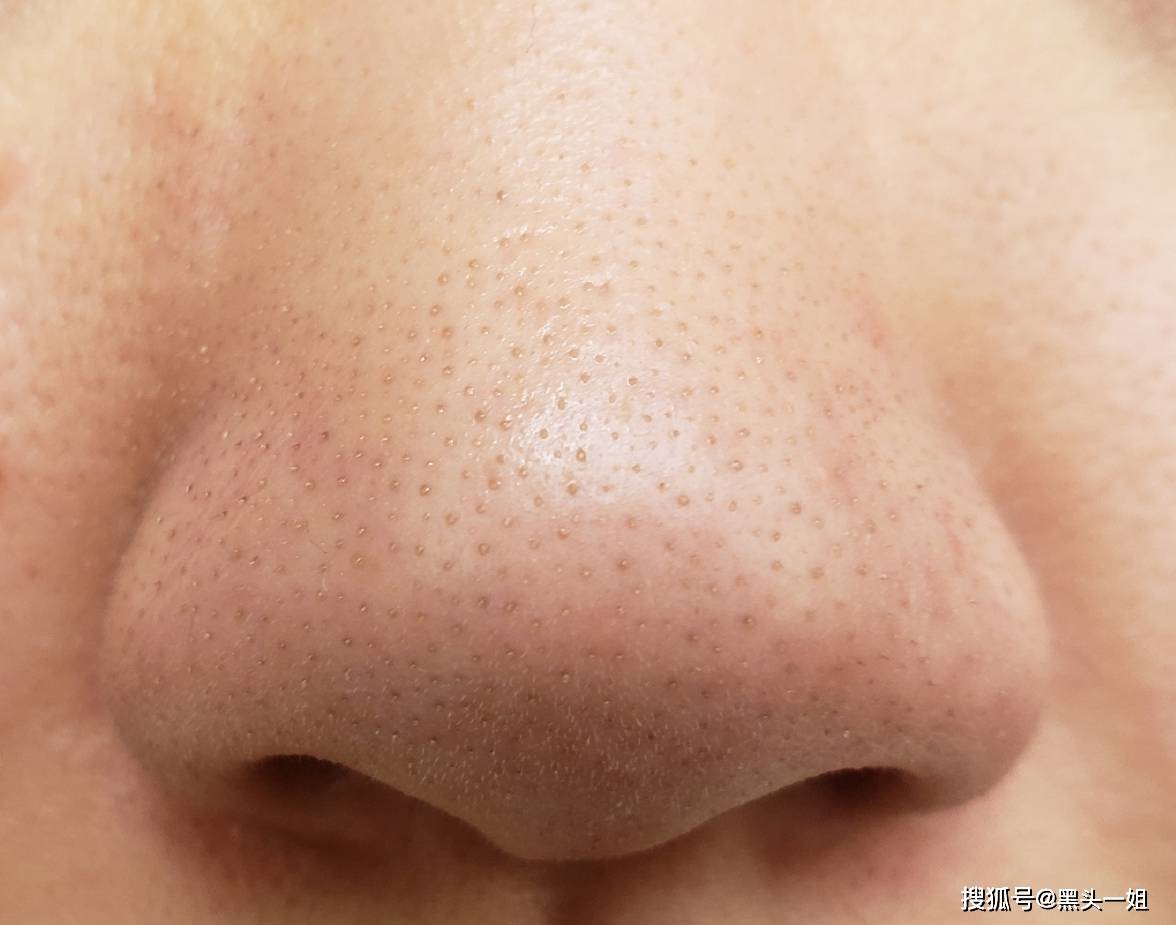 如何自己在家做小气泡去黑头?