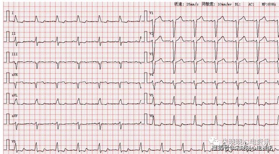 患者女,87岁,因长期胸闷来医院就诊,图为其体检心电图