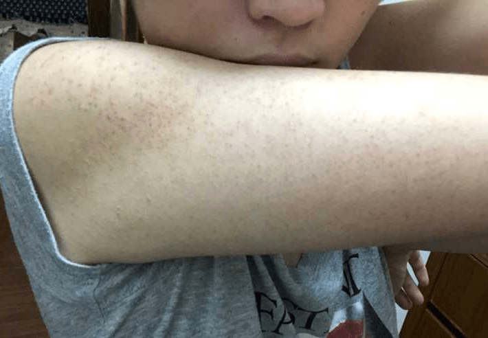 如何治疗手臂鸡皮疙瘩皮肤(手臂皮肤粗糙鸡皮疙瘩怎么办)