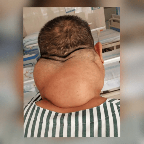 经过ct及彩超等综合检查,吴大爷患上的是罕见的"马德龙病",这种疾病的