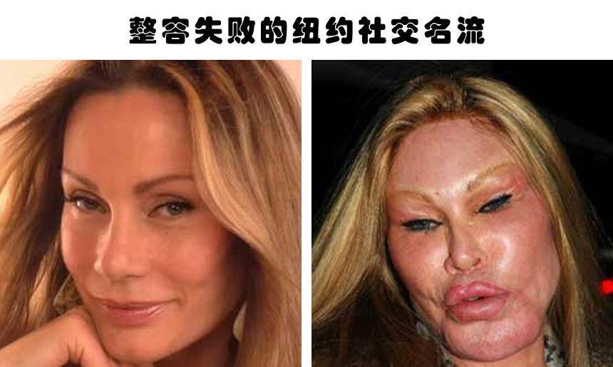 整容失败的代价:据说因为整容而毁掉了自己容貌的6个人