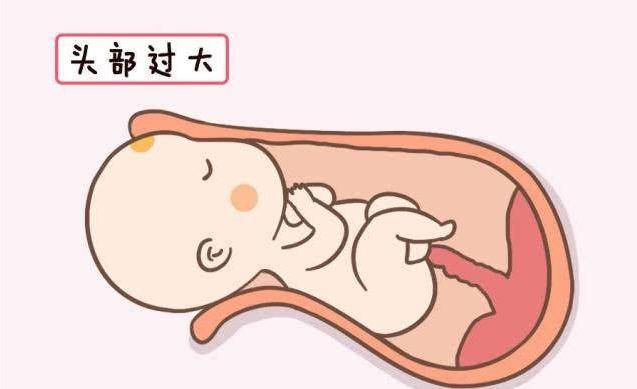 原创"分娩不是你想顺,想顺就能顺",除了胎儿体重,还有几个因素