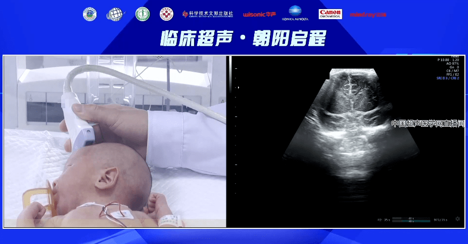 临床超声朝阳启程第四讲新生儿小儿颅脑及肺超声成功开讲