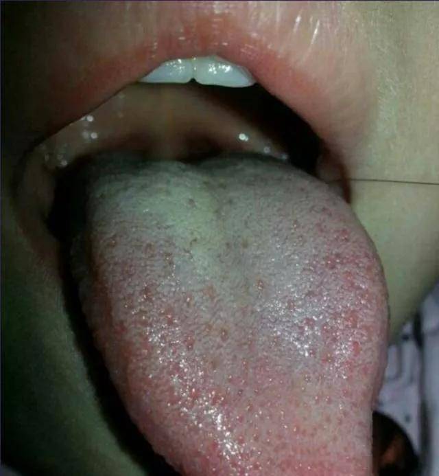 8,看舌苔的真假;(1)舌苔紧贴舌面,不易刮去,似从舌体上长出来的为真苔