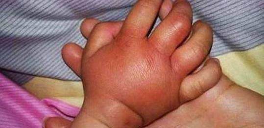婴儿手指红肿硬图片图片