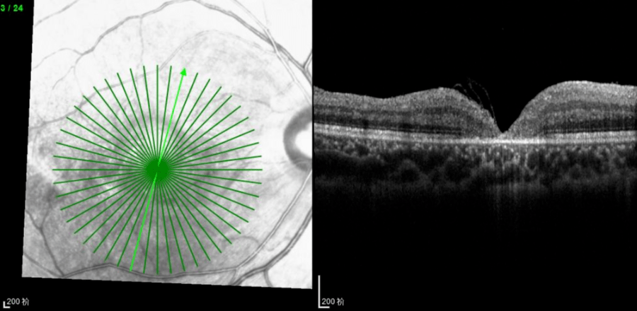 术后oct检查照显示裂孔已闭合