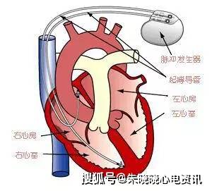 然后我就有疑问,是起搏器设置的模式不一样吗?它的工作原理是什么呢?