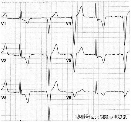 可以对身体没有任何影响,也可能出现室速,室颤等恶性心律失常