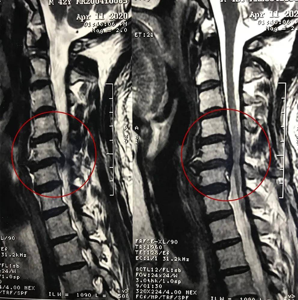 脊髓型颈椎病磁共振图片