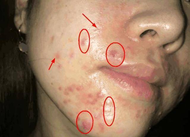 螨虫毁了容貌,爱美之心人皆有,想要颜值除螨势在必行