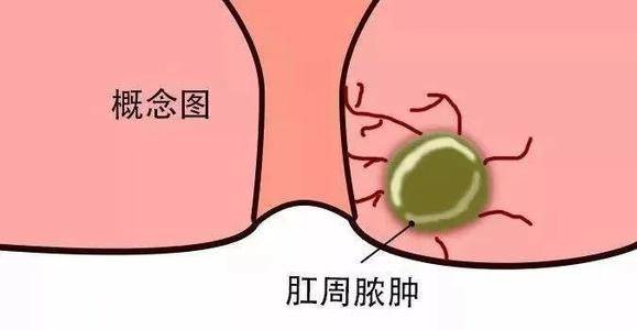 痔疮治疗：从饮食调整到科学疗法