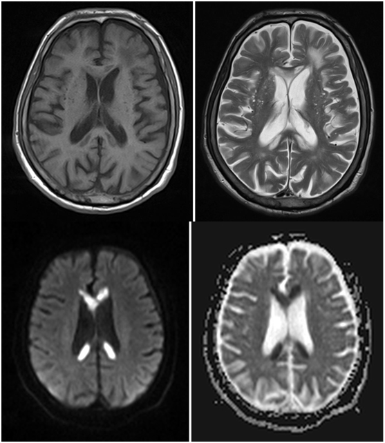 等人於 1981 年首次描述了 sesa 綜合徵(subacute encephalopathy