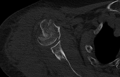 胡医生|【杭州城东医院丨案例】“新技术”为“肱骨近端粉碎骨折”患者复原