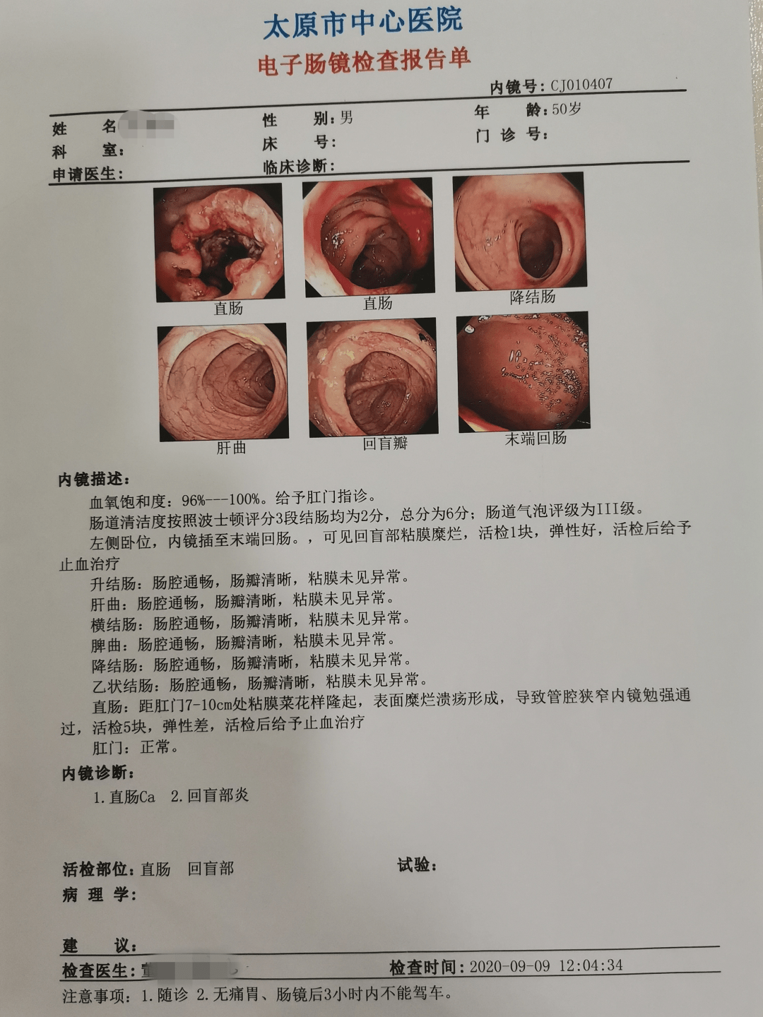 结肠癌报告图片