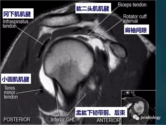 肩袖间隙的解剖及常见病变