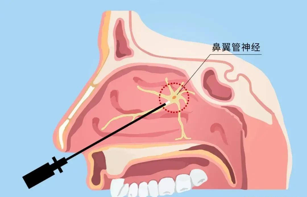 的是高选择性翼管神经(鼻后神经)切断术,合并或者没有合并鼻甲手术